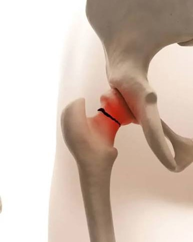 Hip Fracture Treatment in Mumbai